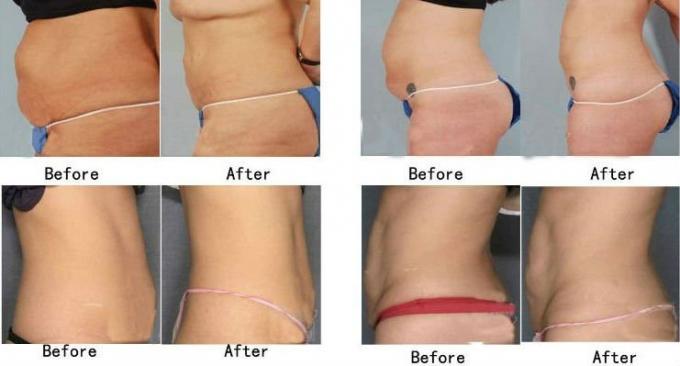 Профессиональное lipo лазера zerona с хорошими результатами